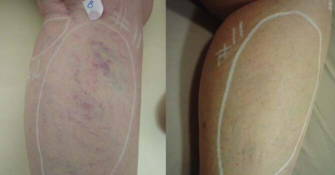 Varicose Vein Laser Removal