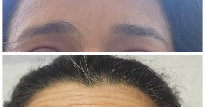 BOTOX AND XEOMIN image