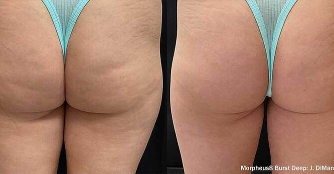 Morpheus 8 Deep Burst